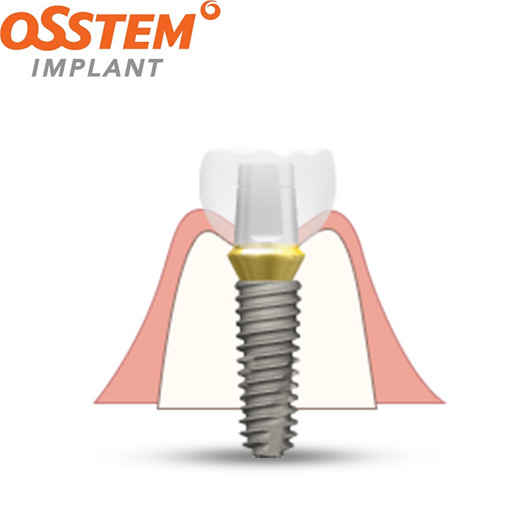 오스템(OSSTEM) 임플란트