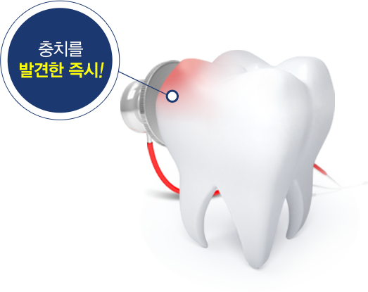충치를 발견한 즉시! — 청진기를 댄 치아