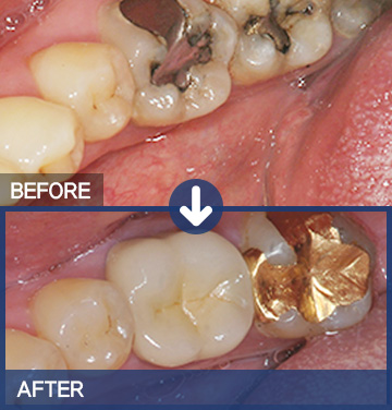 지르코니아 (Zirconia) 치료 전(BEFORE)·후(AFTER)