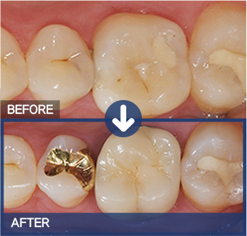 금크라운 (Gold Crown) 치료 전(BEFORE)·후(AFTER)